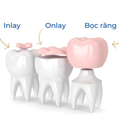 Trám sứ Inlay/Onlay