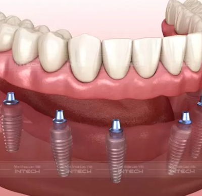 implant toàn hàm