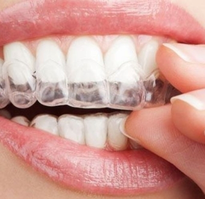 Niềng răng INVISALIGN