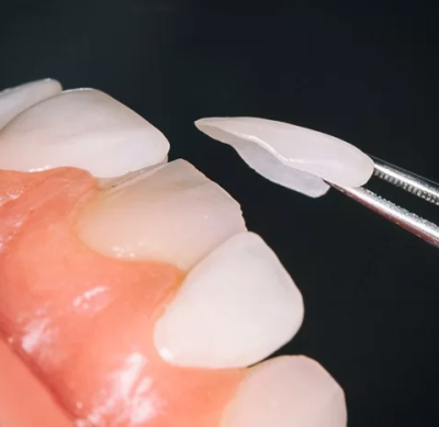 Dán sứ Veneer