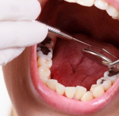 Trám Răng Lấy Tủy