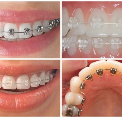 Niềng răng mắc cài