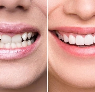 Răng sứ thẩm mỹ