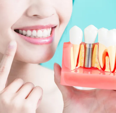 Trồng răng implant