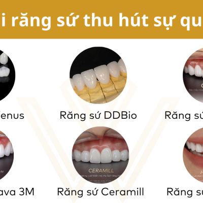 So sánh các loại răng sứ phổ biến hiện nay