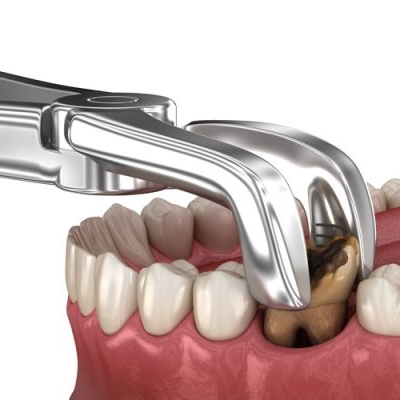 Nhổ Răng Có Đau Không? Sự Thật và Hiểu Lầm