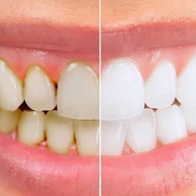 Lấy cao răng giá rẻ quận 8