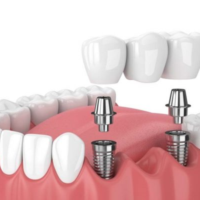 Trồng răng Implant tại nha khoa Quận 8 có đau không?