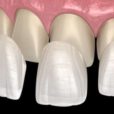 dán sứ veneer quận 8