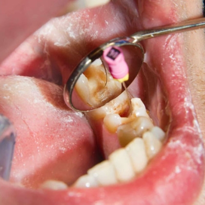 Điều trị nội nha mất bao lâu? Có cần đi nhiều lần không?
