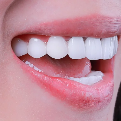 Tẩy trắng răng quận 8