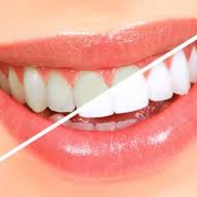 Tẩy trắng răng tại nhà quận 8