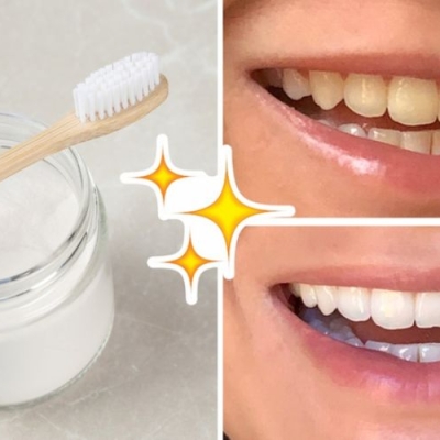 Tẩy trắng răng giá bao nhiêu quận 8