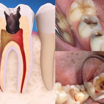 Các Bệnh Lý Nha Khoa Thường Gặp