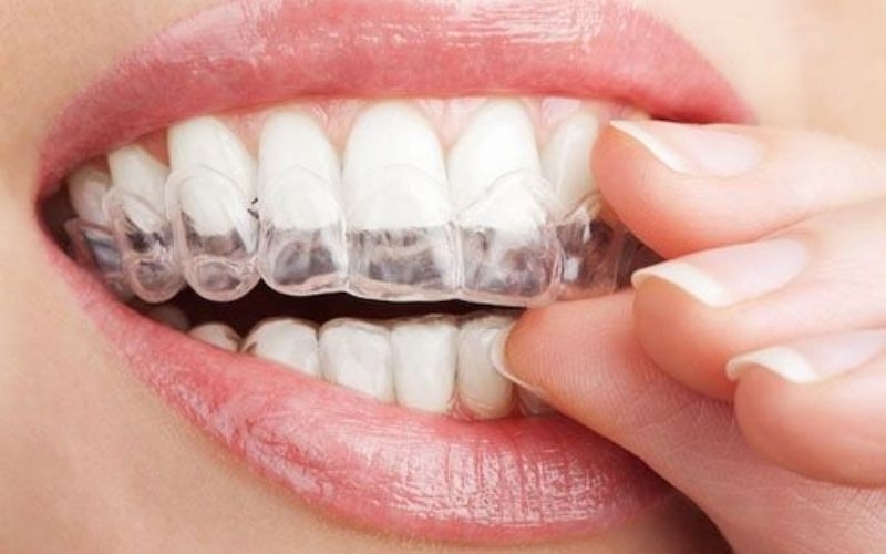 công nghệ niềng răng invisalign quận 8 thông minh