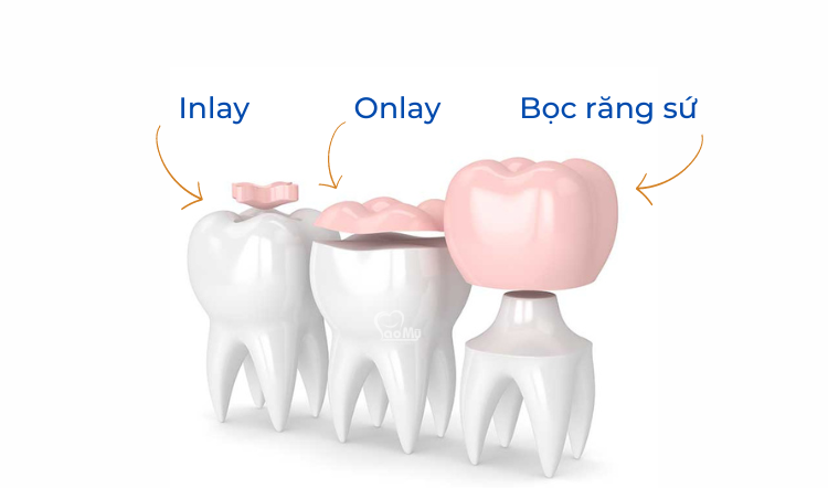 so sánh trám sứ inlay/onlay và bọc sứ