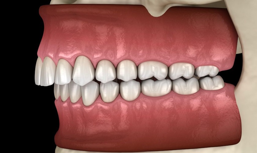 hiệu quả niềng răng invisalign thực tế