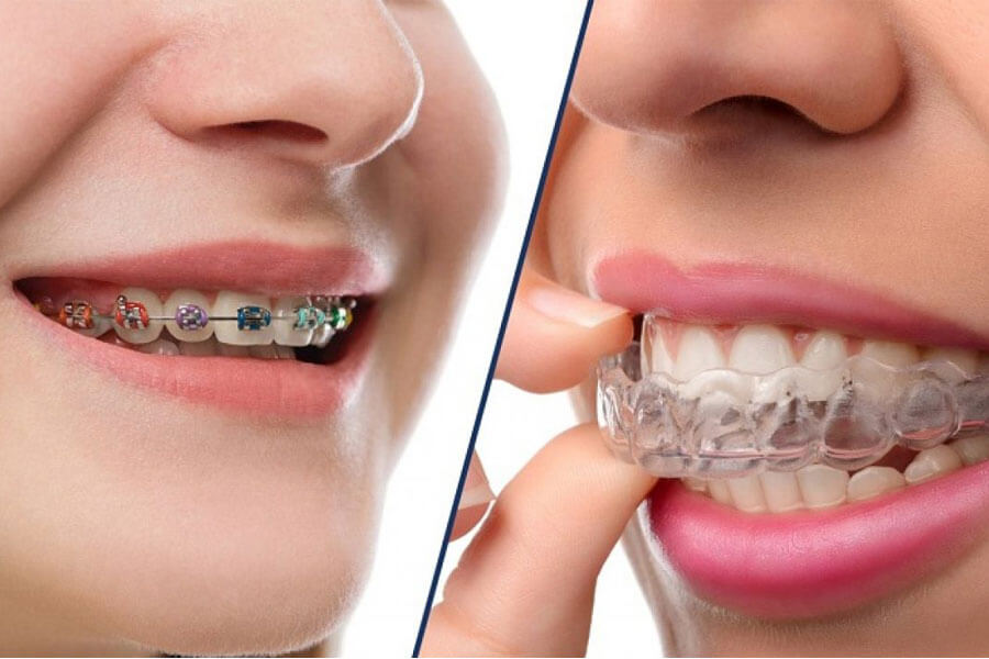 các phương pháp chỉnh nha quận 8 hiện đại