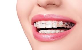 lợi ích khi biết niềng răng giá bao nhiêu quận 8 tại mỹ nhân