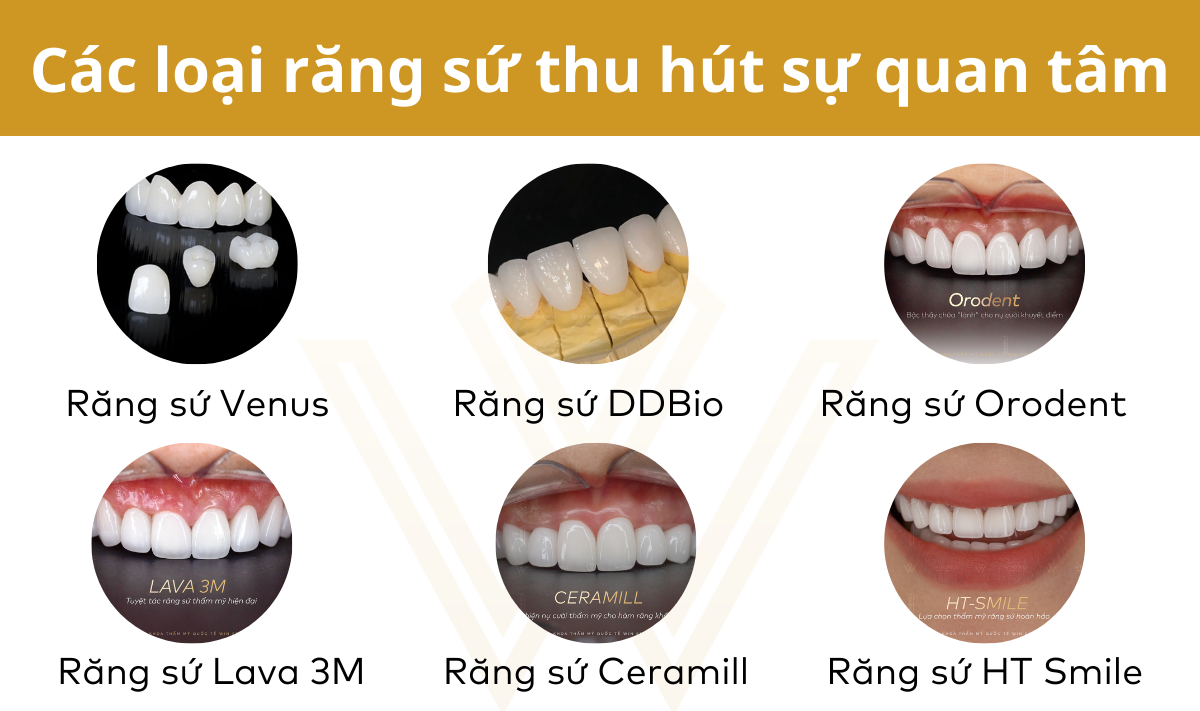 so sánh các loại răng sứ phổ biến hiện nay dòng kim loại