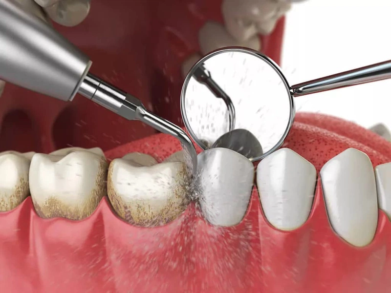 răng sạch khỏe sau khi lấy cao răng tại quận 8