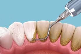 lấy cao răng giá rẻ quận 8 an toàn hiệu quả