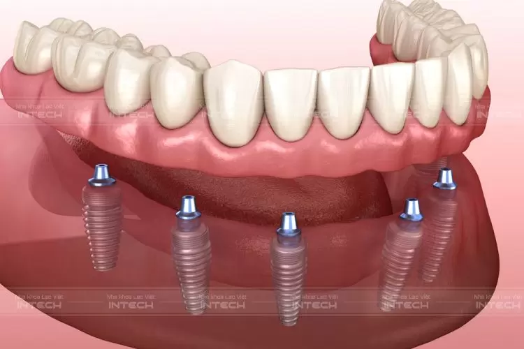 implant toàn hàm khôi phục nụ cười