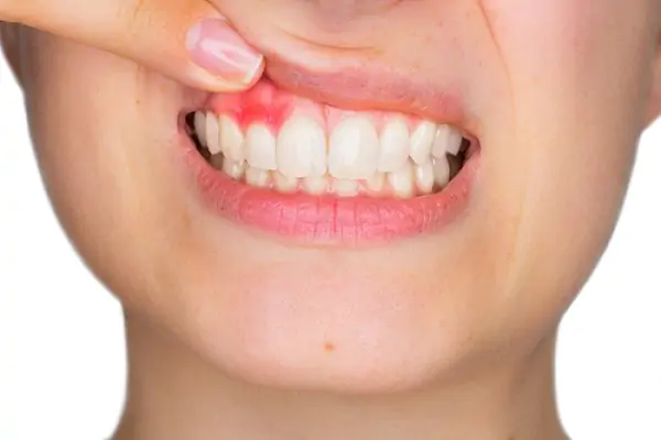 Dịch vụ bọc răng sứ tại giới thiệu nha khoa