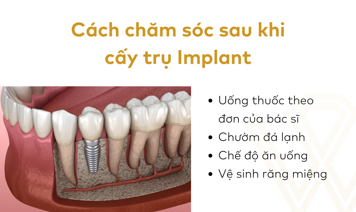 chăm sóc răng implant toàn hàm đúng cách