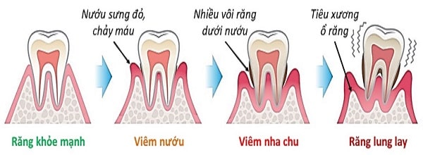Răng khôn mọc lệch trong Các Bệnh Lý Nha Khoa Thường Gặp