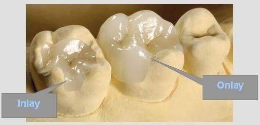 trám sứ inlay/onlay phục hồi răng