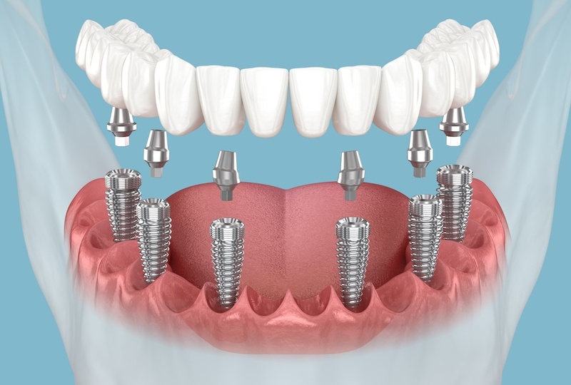 các kỹ thuật cấy ghép implant toàn hàm