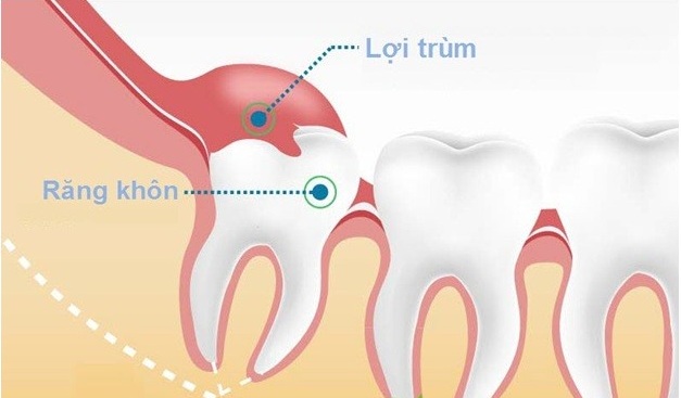 Quy trình nhổ răng khôn an toàn tại nha khoa