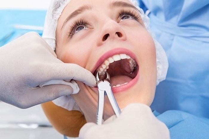 Quy trình nhổ răng khôn chuyên nghiệp không đau