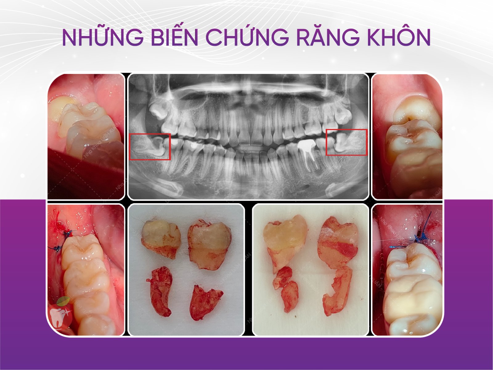 Các tư thế mọc răng khôn cần phải nhổ bỏ
