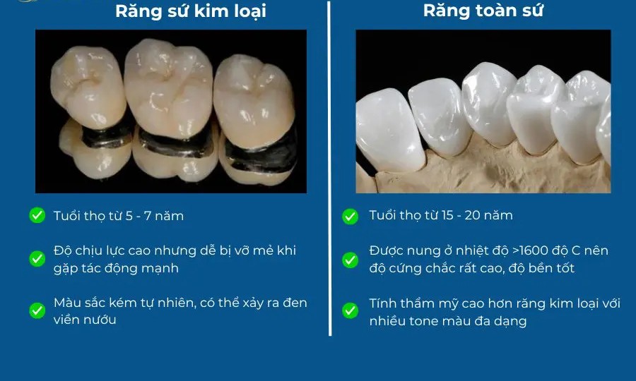 các loại răng sứ thẩm mỹ phổ biến