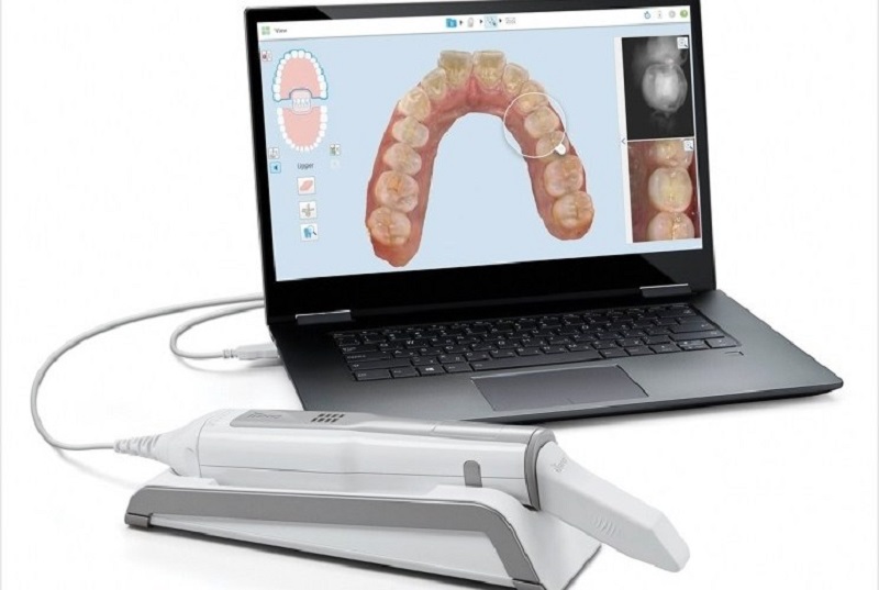 quy trình niềng răng invisalign kỹ thuật số