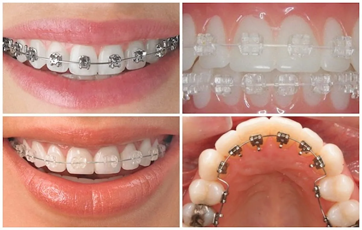 các phương pháp niềng răng quận 8 hiện đại