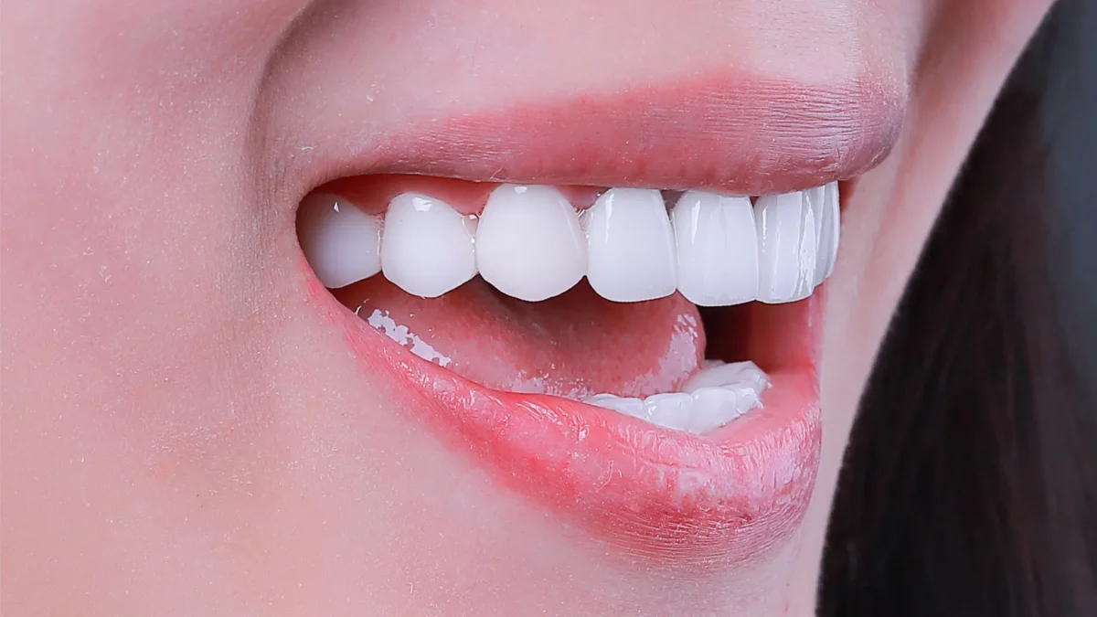 lưu ý quan trọng khi tẩy trắng răng tại nhà quận 8