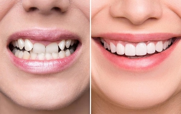 lợi ích bọc răng sứ thẩm mỹ