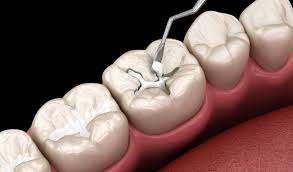 trám răng thẩm mỹ tại nha khoa mỹ nhân