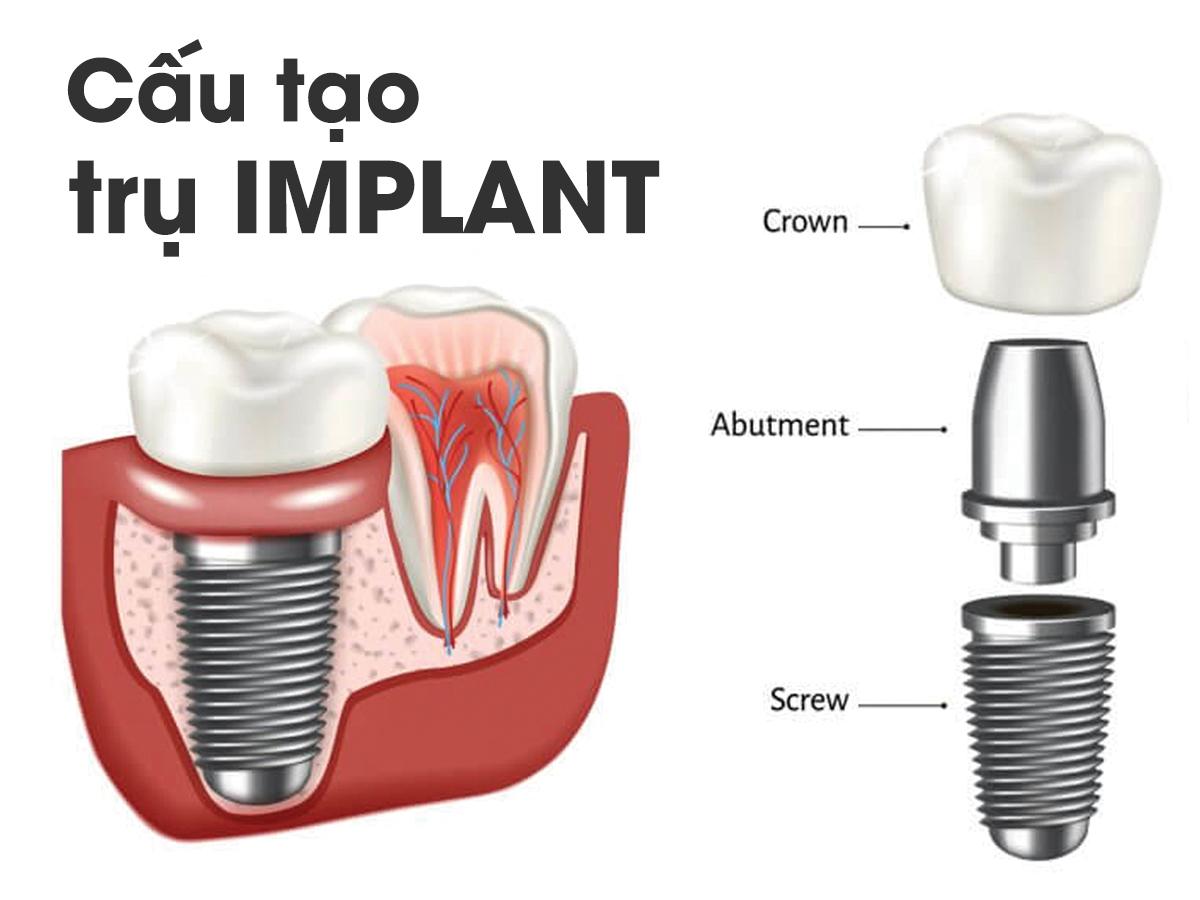 Quy trình cấy ghép Implant chuyên nghiệp tại Mỹ Nhân