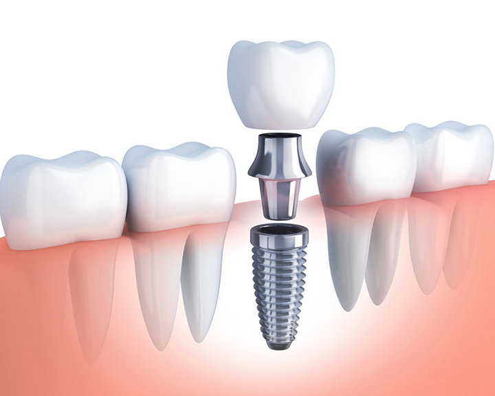Bảng giá và các loại trụ trồng răng Implant