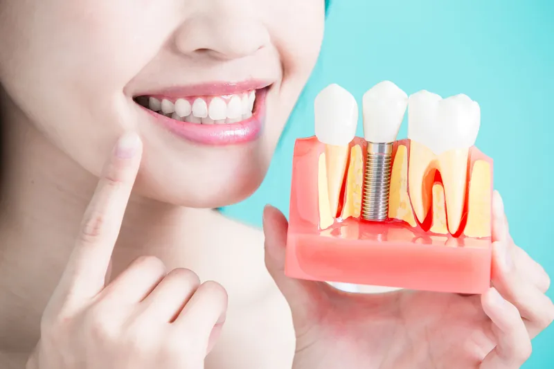 Lợi ích tuyệt vời của phương pháp trồng răng Implant