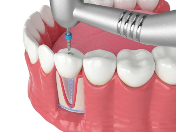 Bọc răng sứ bảo vệ răng sau khi trám răng lấy tủy