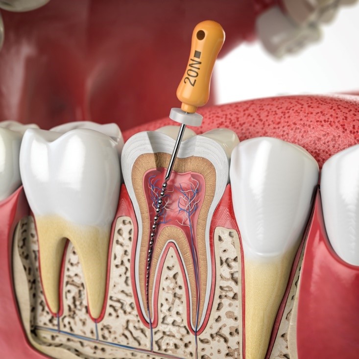 Quy trình trám răng lấy tủy chuyên nghiệp tại Nha khoa Mỹ Nhân