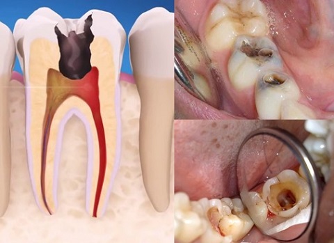 Sâu răng và viêm tủy trong Các Bệnh Lý Nha Khoa Thường Gặp