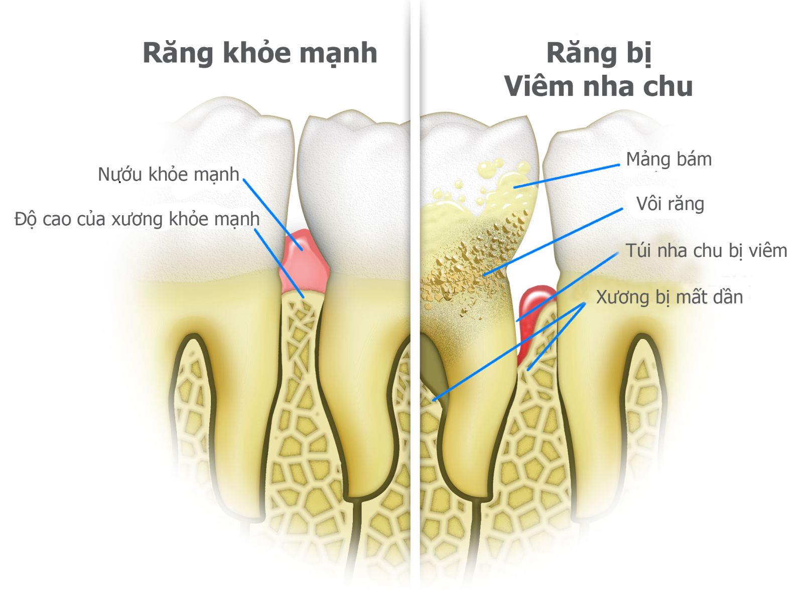 Bệnh viêm nha chu trong Các Bệnh Lý Nha Khoa Thường Gặp