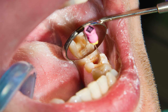Điều trị nội nha